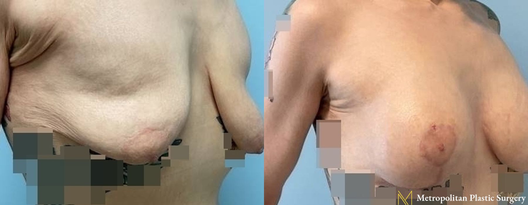Breast Lift - Thumbnail 2