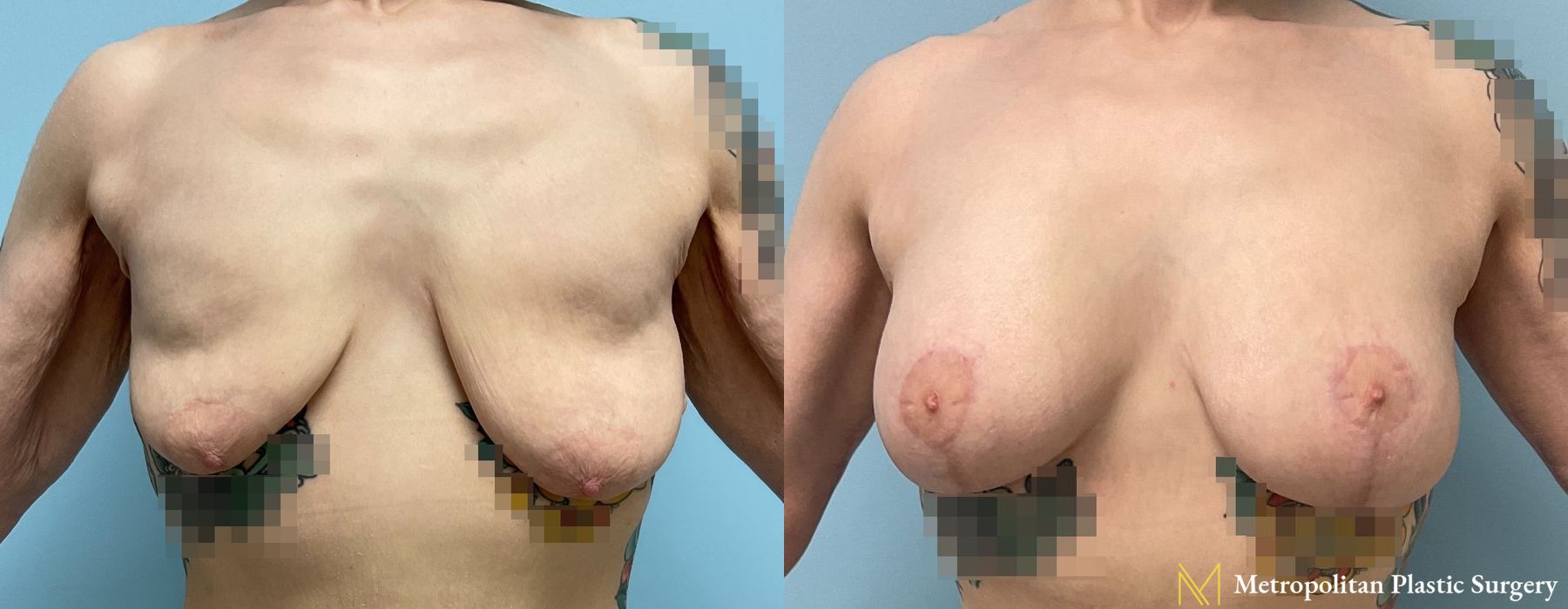 Before and after Fat Grafting case 8093