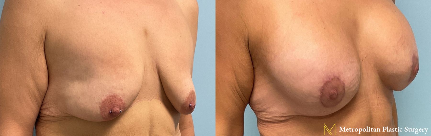 Before and after breast augmentation surgery by Julia Spears MD - Angle 3