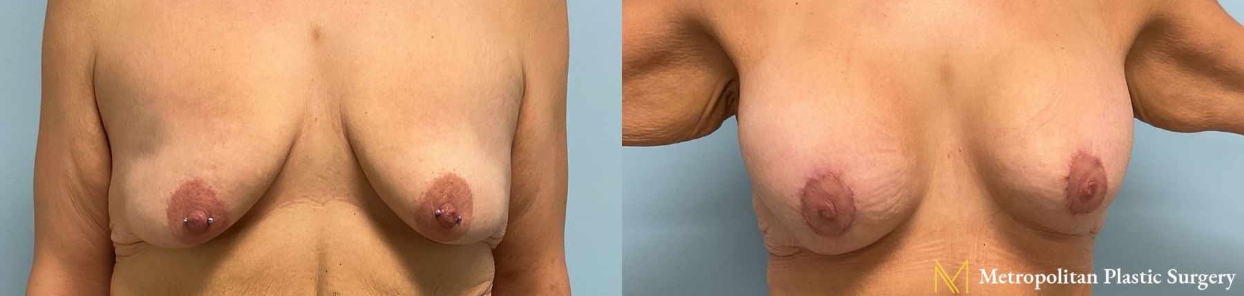 Before and after breast augmentation surgery by Julia Spears MD
