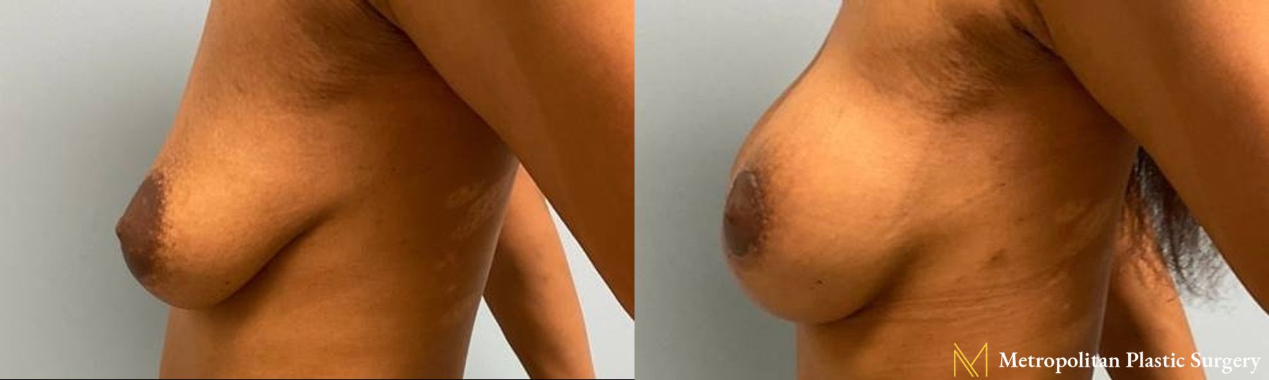 Before and after Mommy Makeover case 8095 - Angle 3