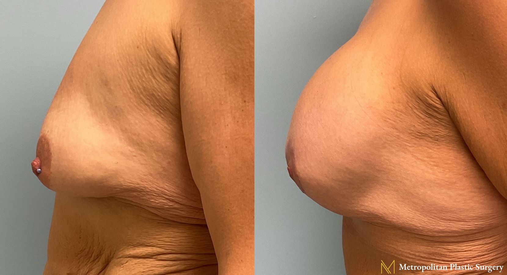 Before and after breast augmentation surgery by Julia Spears MD - Angle 4
