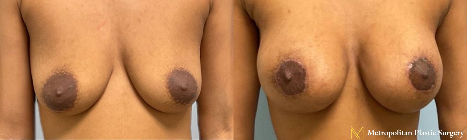 Before and after Mommy Makeover case 8095