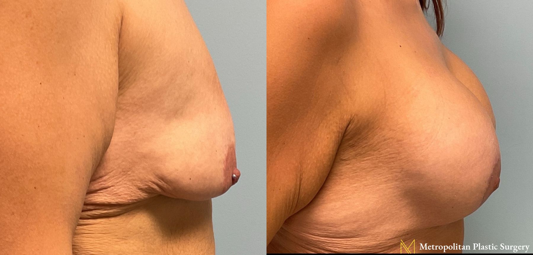 Before and after breast augmentation surgery by Julia Spears MD - Angle 2