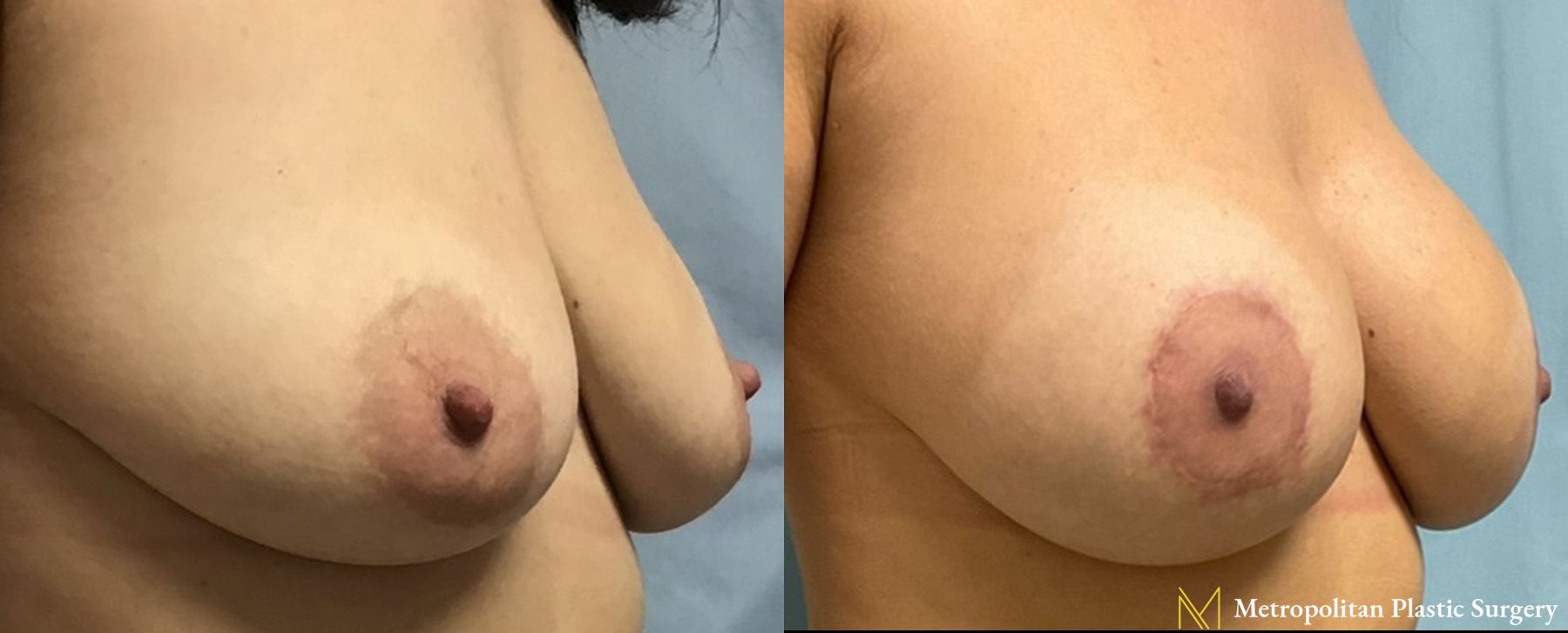 Before and after breast lift with implants surgery by Julia Spears MD - Angle 3