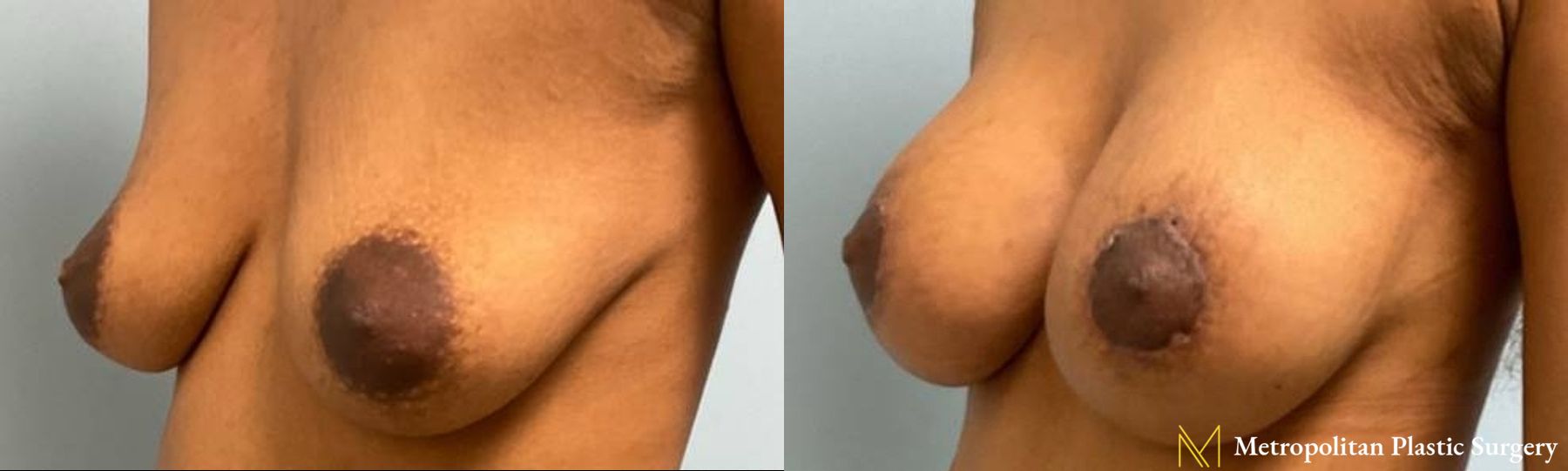 Before and after Mommy Makeover case 8095 - Angle 2
