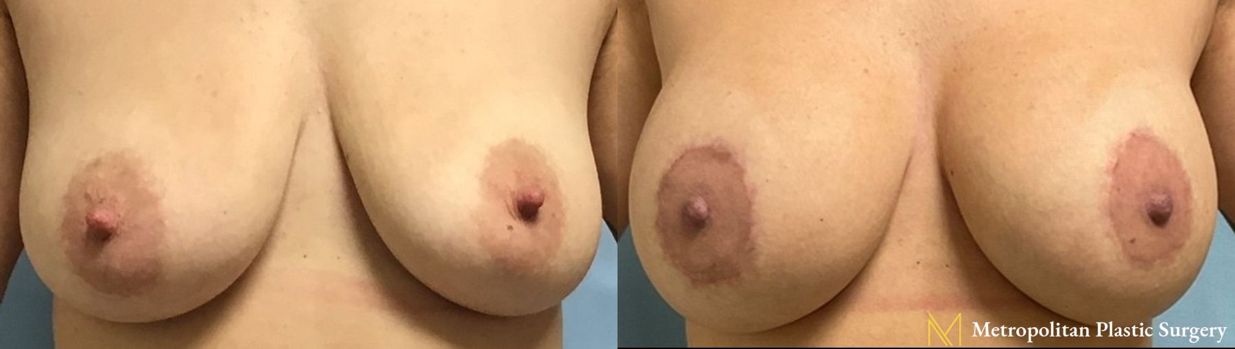 Before and after breast lift with implants surgery by Julia Spears MD