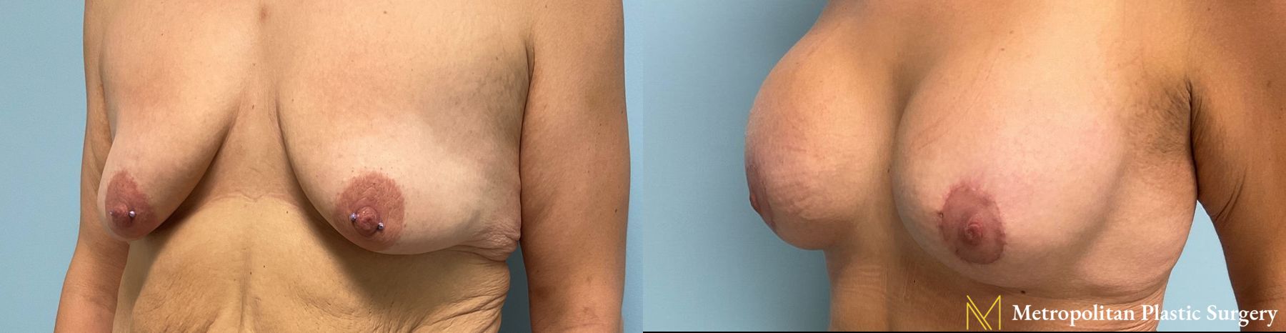 Before and after breast augmentation surgery by Julia Spears MD - Angle 5