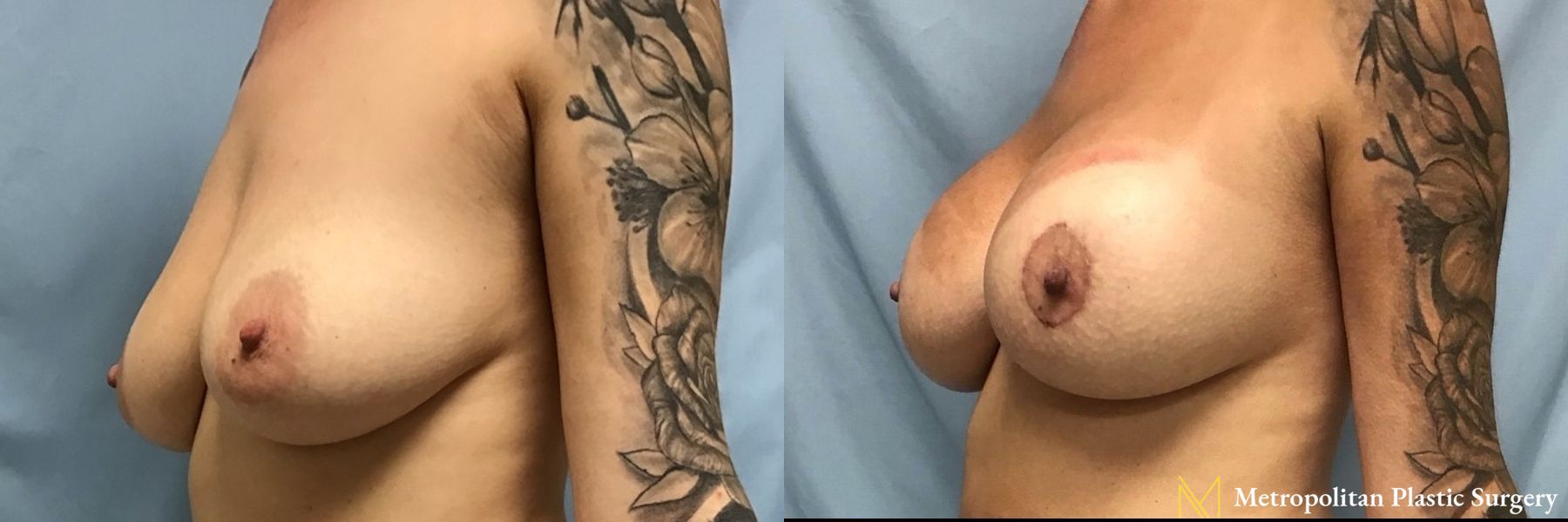 Before and after breast lift with implants surgery by Julia Spears MD - Angle 2