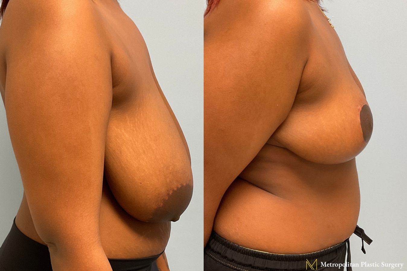 Before and after photos of breast reduction surgery by Julia Spears MD - Angle 5