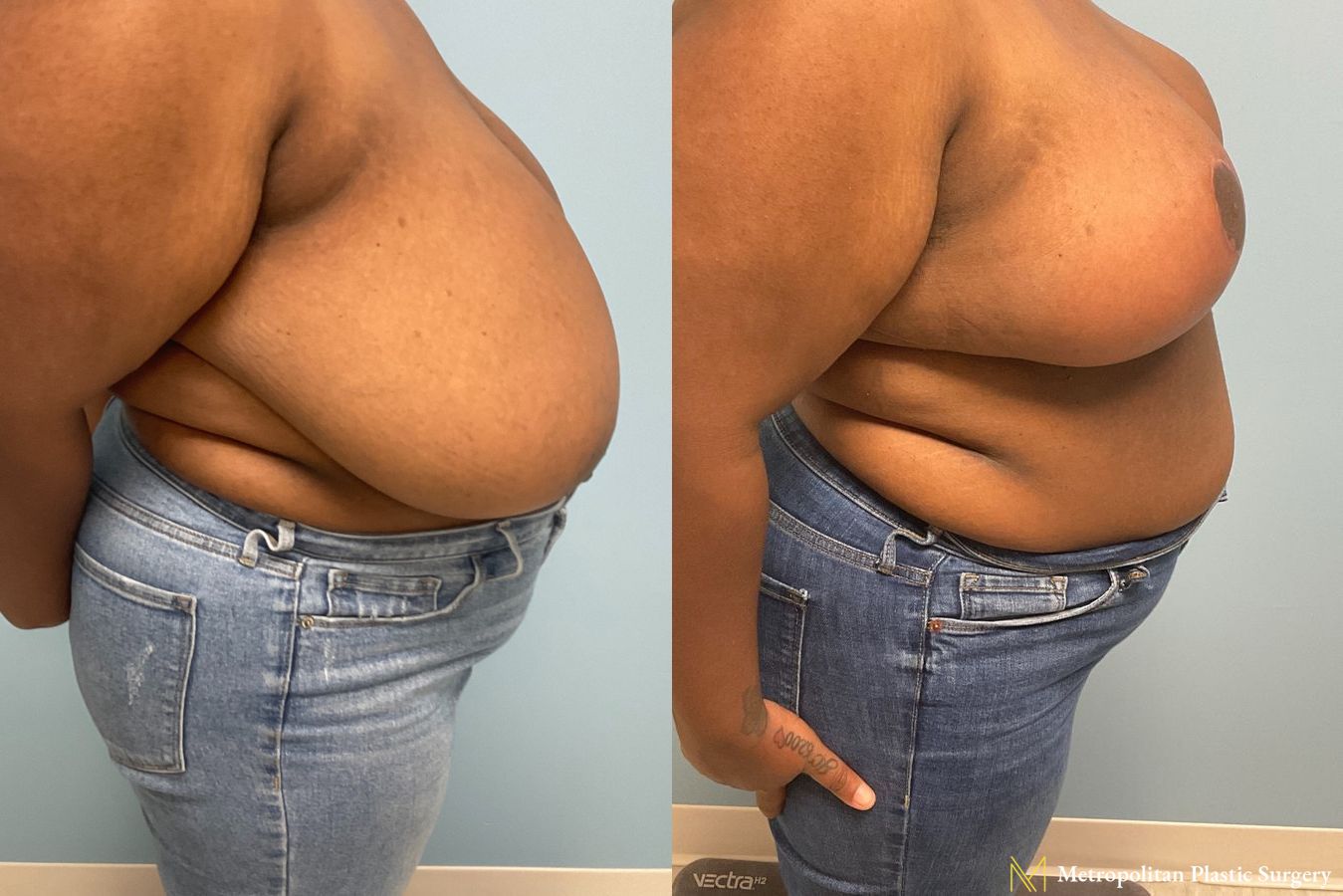 Before and after breast reduction surgery by Julia Spears MD - Angle 4