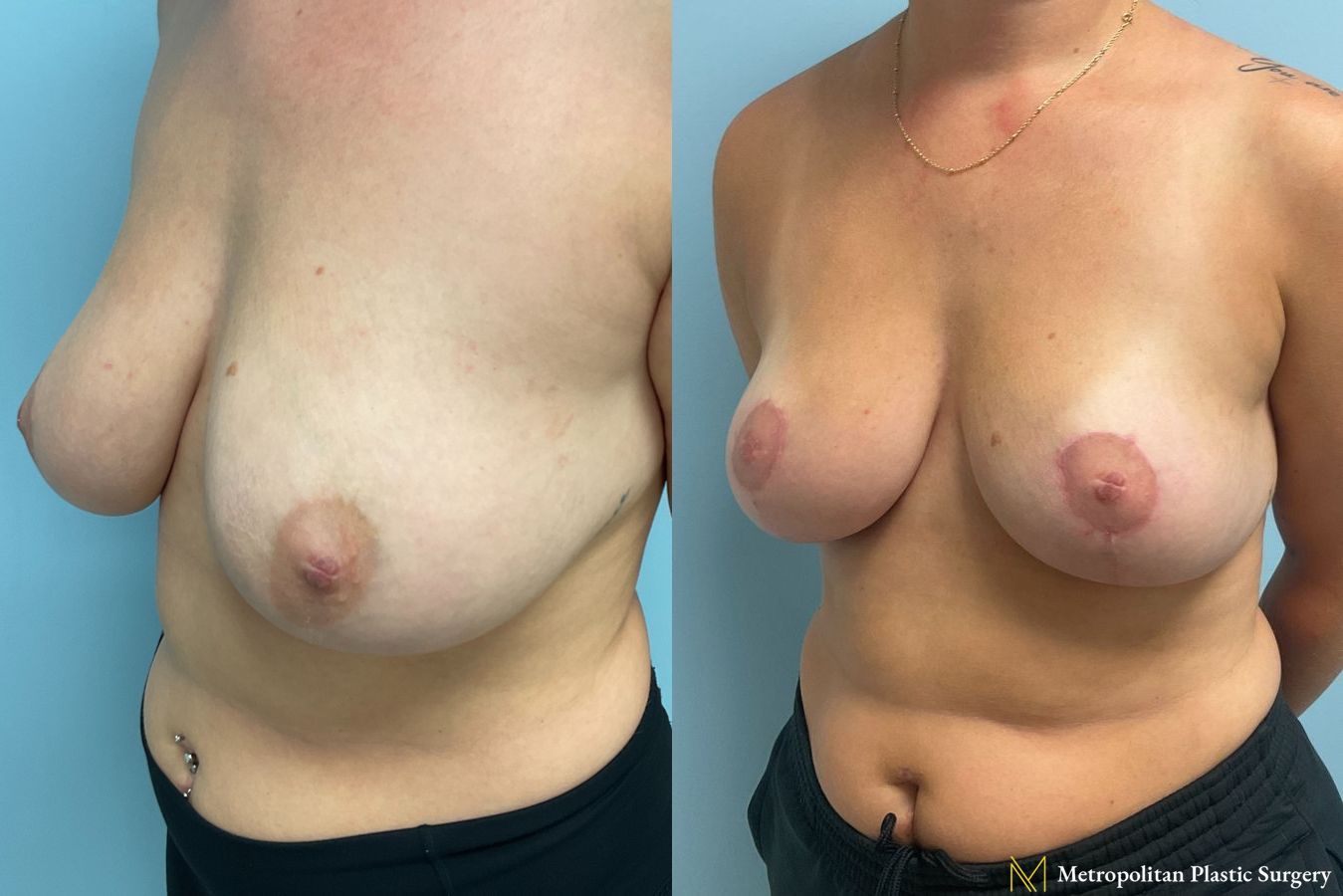 Before and after photos of breast reduction surgery by Julia Spears MD - Angle 3