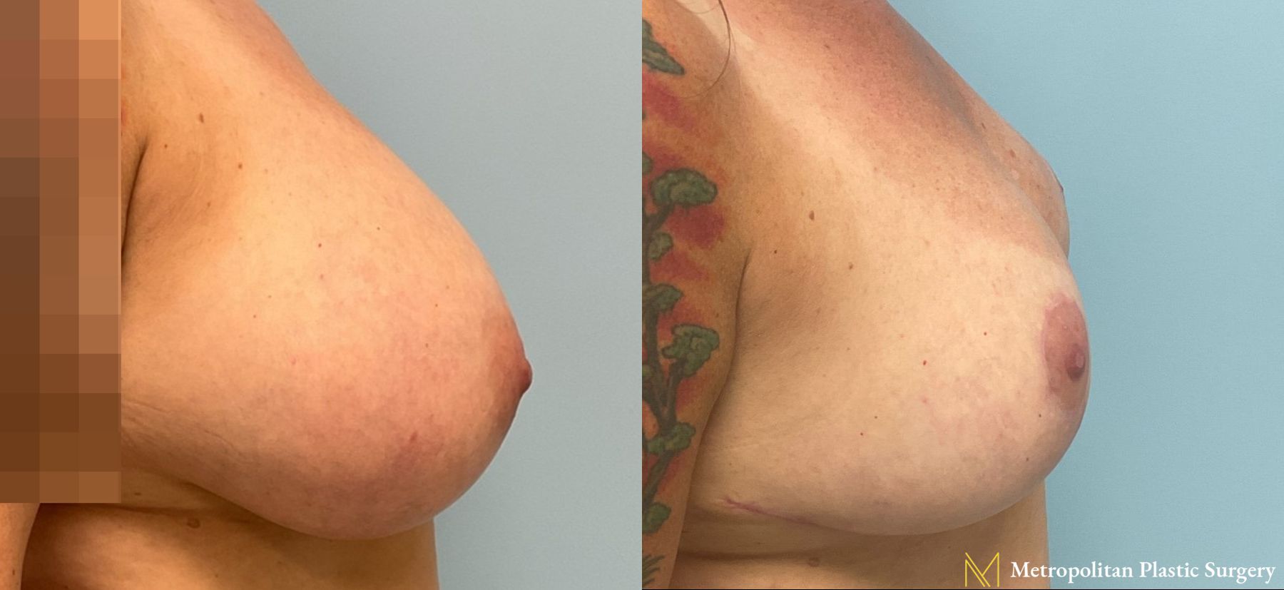 Before and after breast reduction surgery by Julia Spears MD - Angle 4