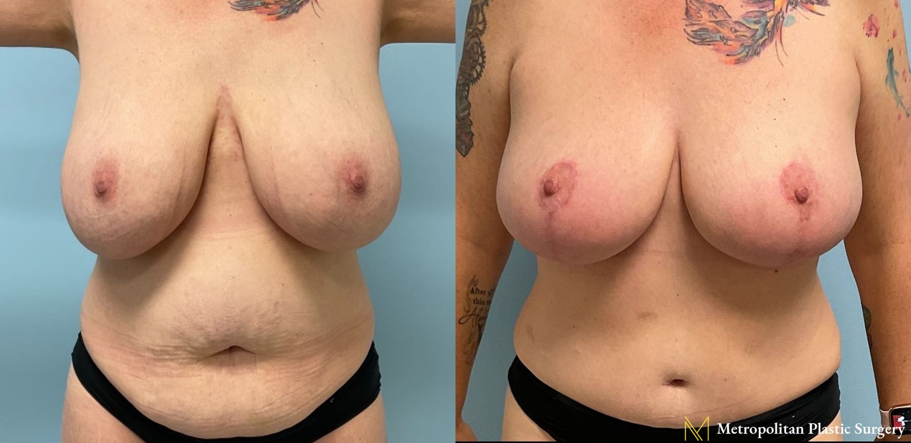 Before and after Mommy Makeover case 8098