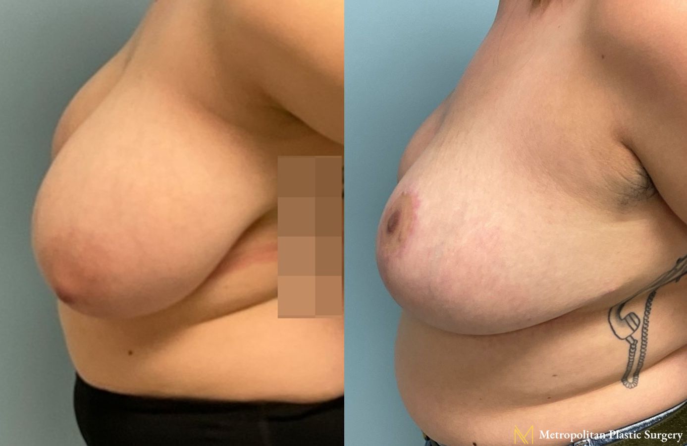 Before and after breast reduction surgery by Julia Spears MD - Angle 2