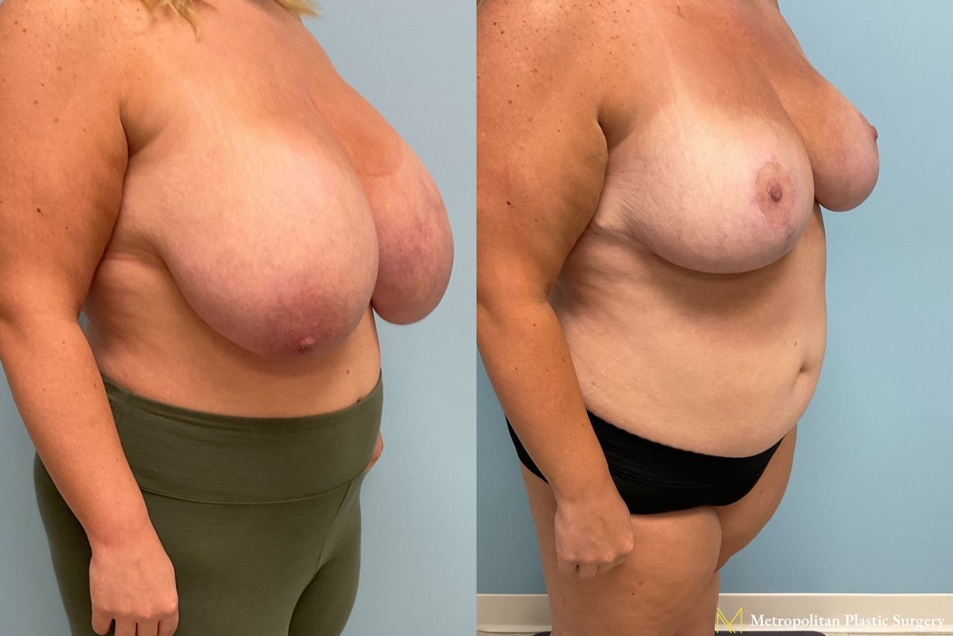 Before and after breast reduction surgery by Julia Spears MD - Angle 5