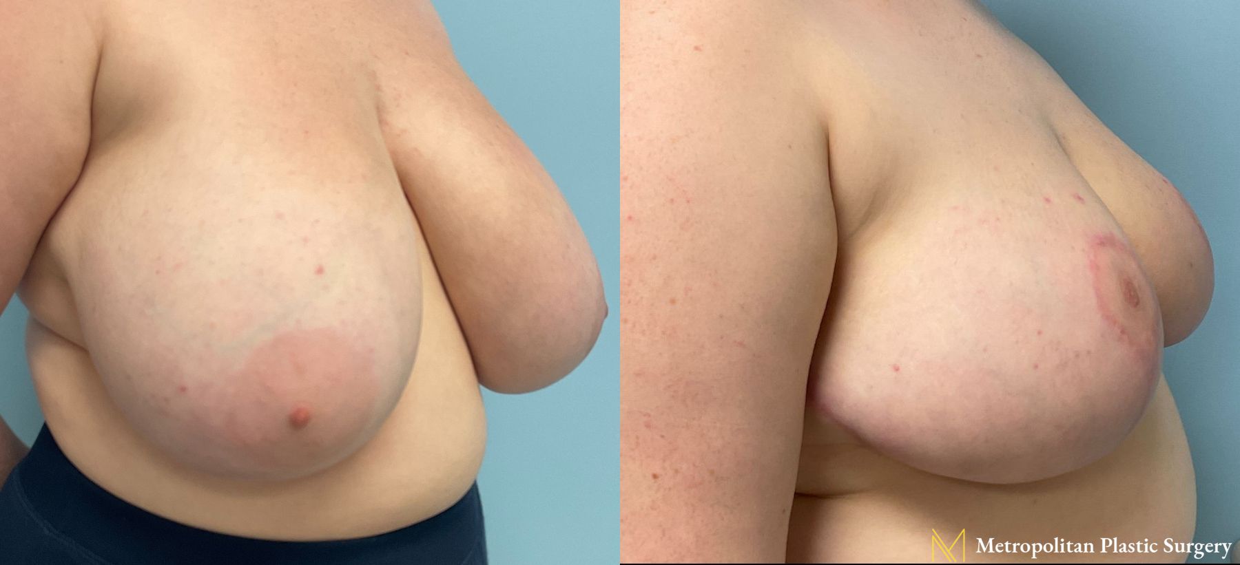 Before and after breast reduction surgery by Julia Spears MD - Angle 5