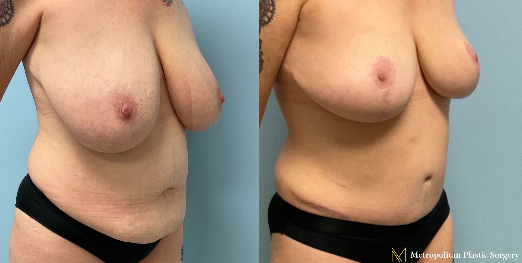 Before and after Tummy Tuck case 19254 - Angle 2