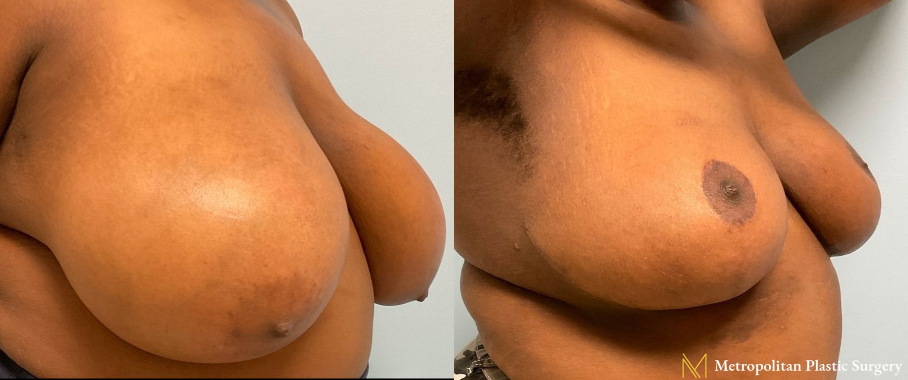 Before and after breast reduction surgery by Julia Spears MD - Angle 2