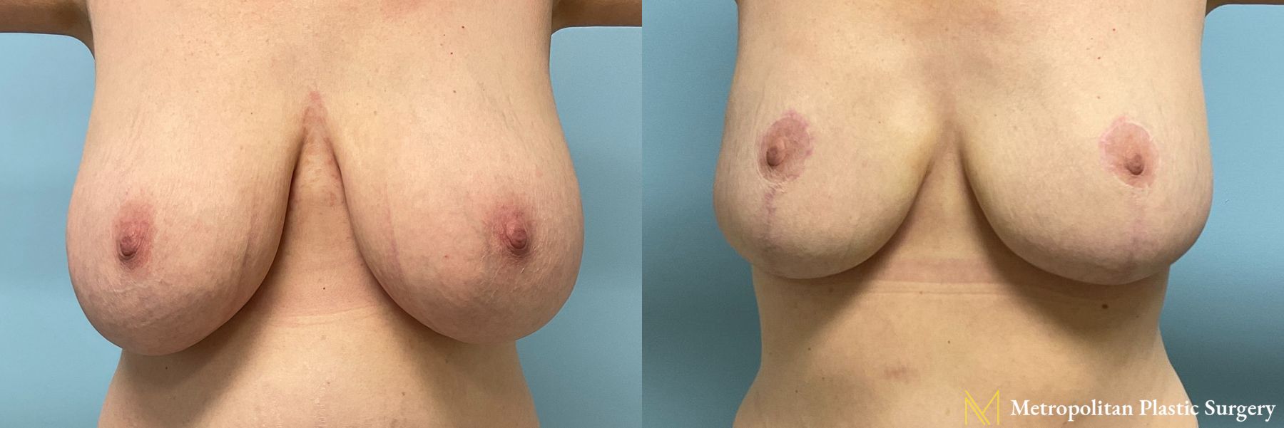 Before and after Breast Reduction case 41779