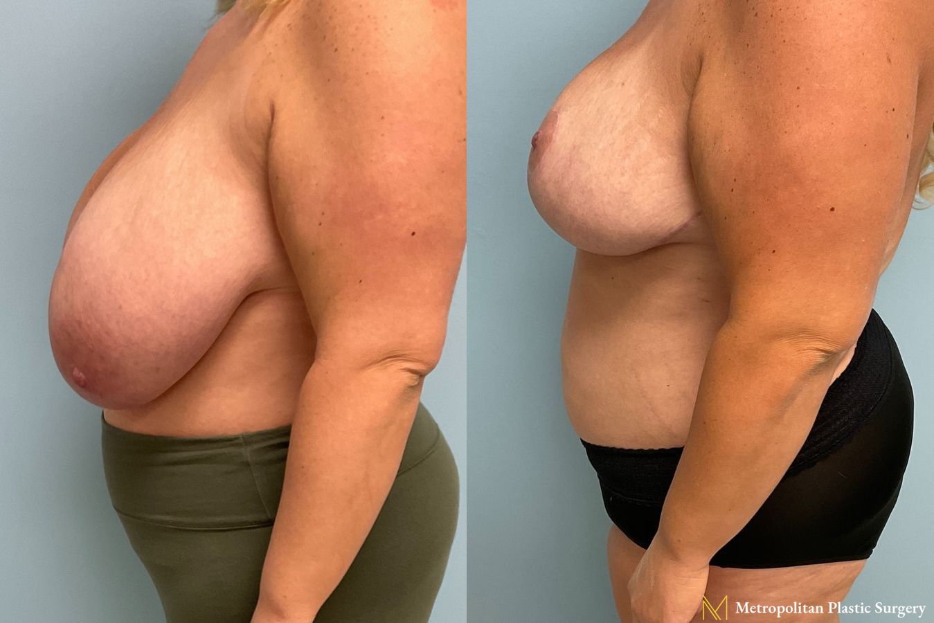 Before and after breast reduction surgery by Julia Spears MD - Angle 2