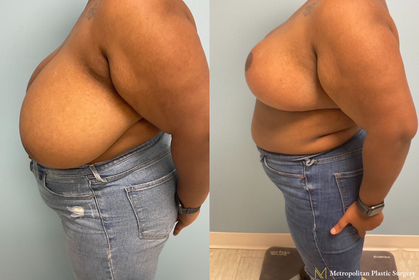 Before and after breast reduction surgery by Julia Spears MD - Angle 2