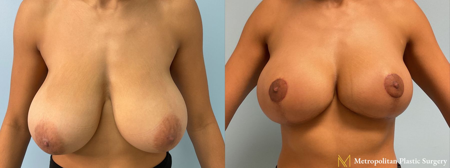 Before and after Breast Reduction case 12953