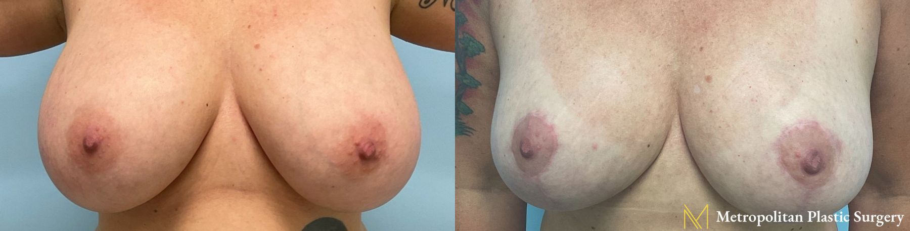 Before and after breast reduction surgery by Julia Spears MD