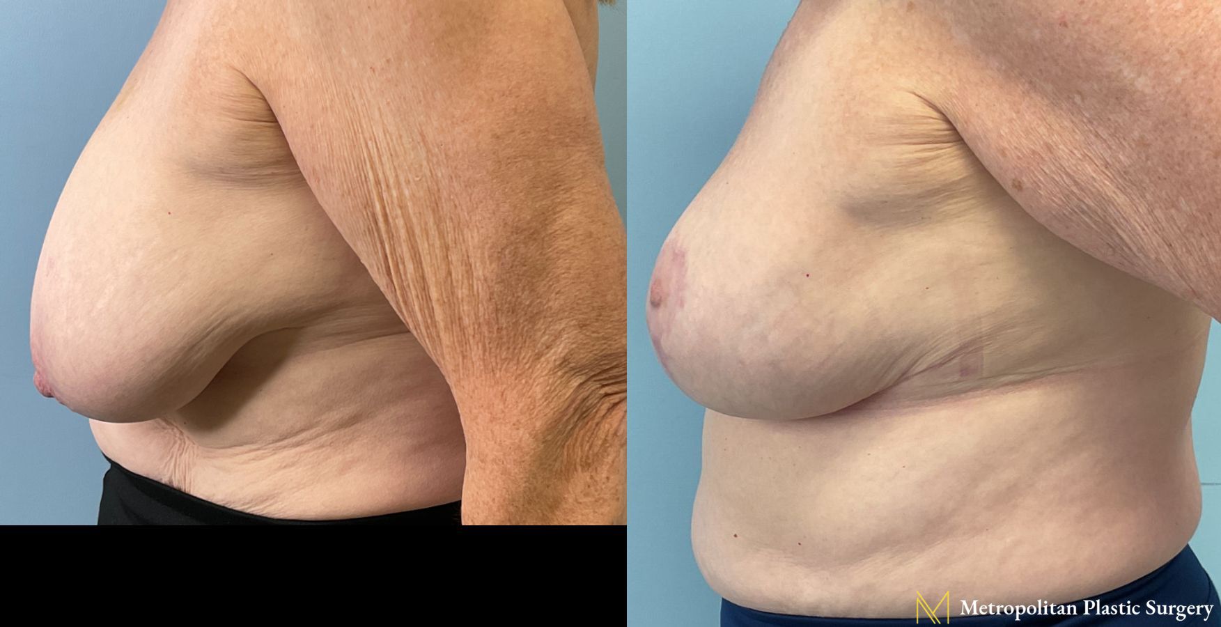 Breast Reduction performed by Dr. Julia Spears - Angle 3