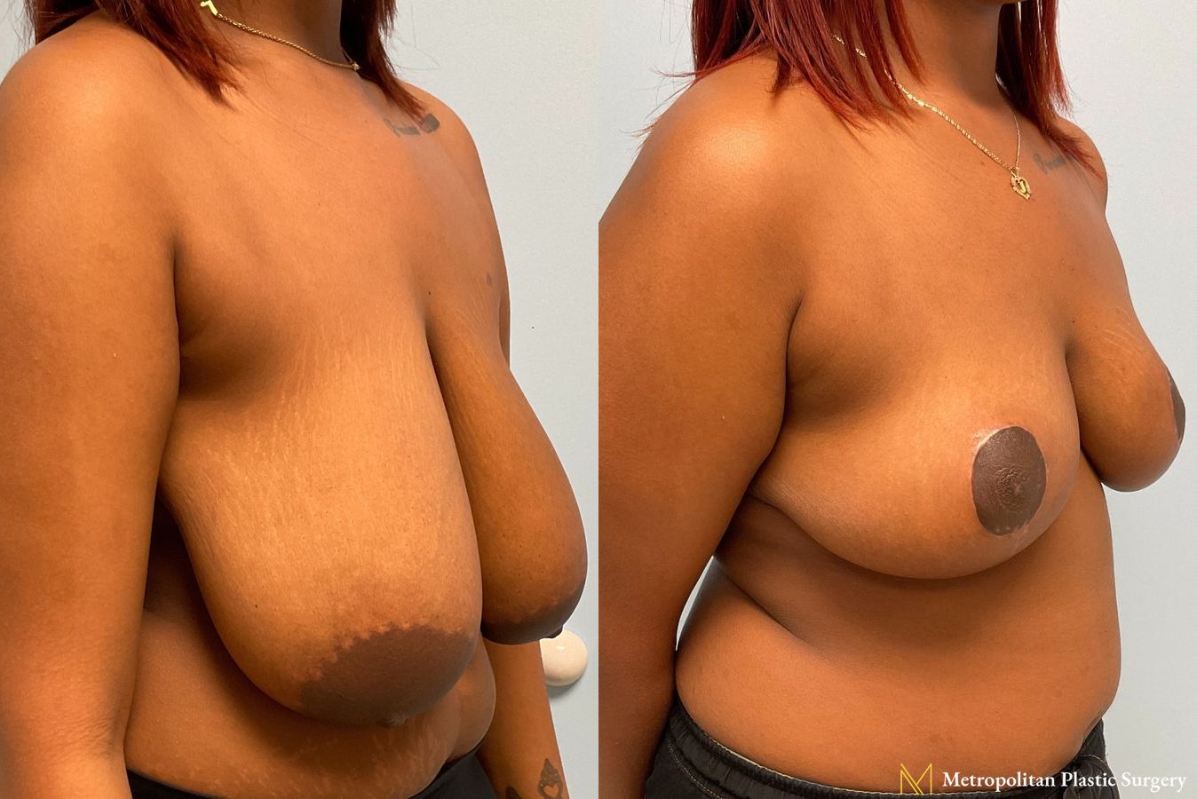 Before and after photos of breast reduction surgery by Julia Spears MD - Angle 4