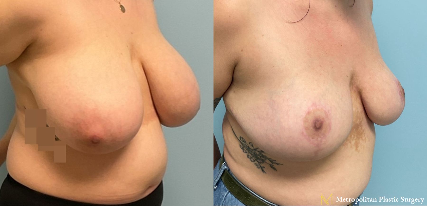 Before and after breast reduction surgery by Julia Spears MD - Angle 3
