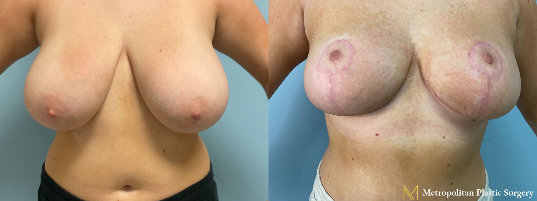 Breast Reduction performed by Dr. Julia Spears - Angle 2