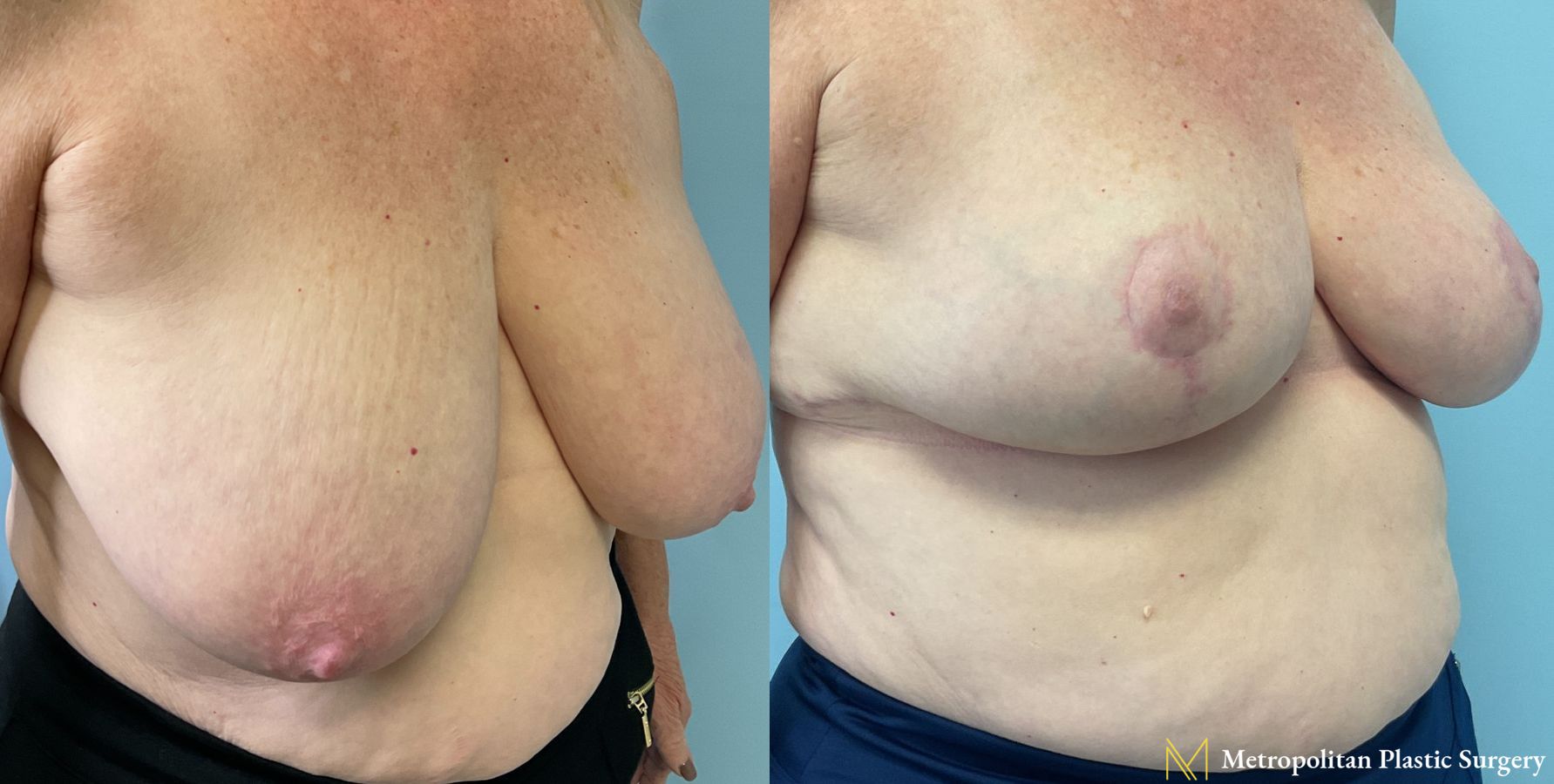 Breast Reduction performed by Dr. Julia Spears - Angle 2