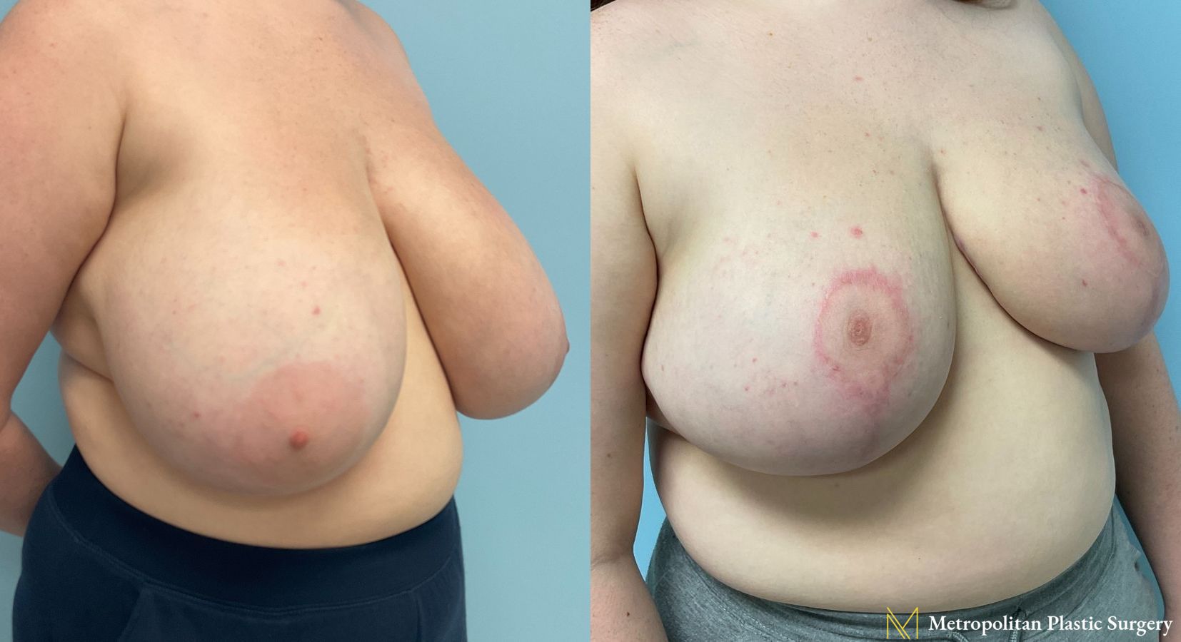 Before and after breast reduction surgery by Julia Spears MD - Angle 2