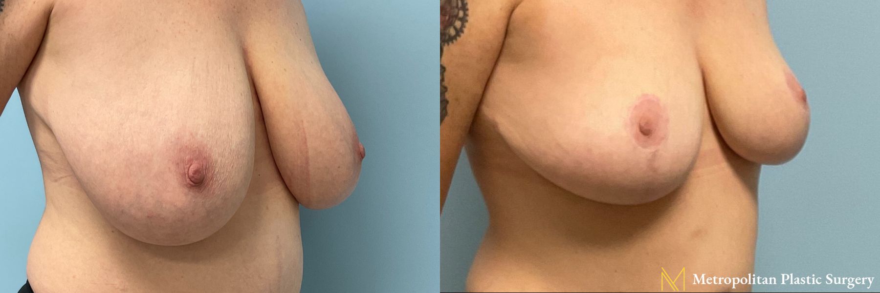 Before and after Breast Reduction case 41779 - Angle 2
