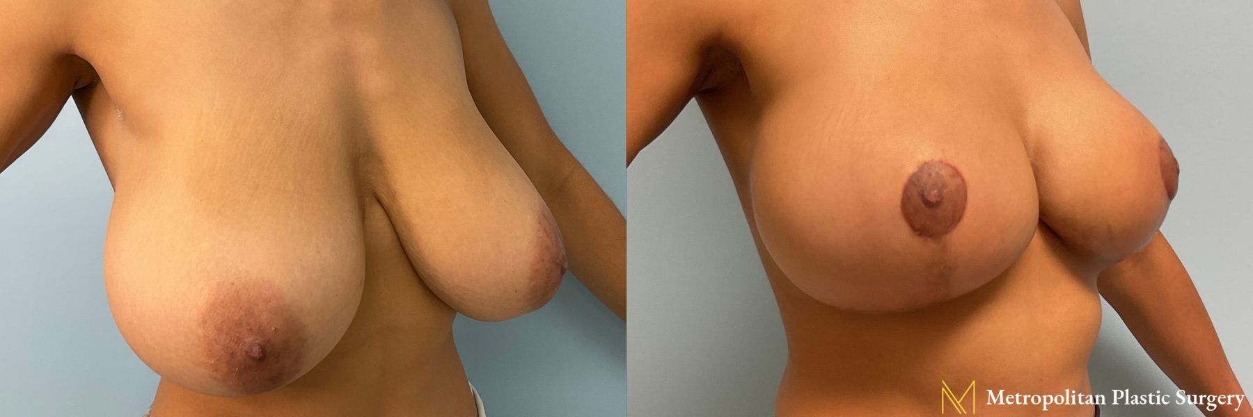 Before and after Breast Reduction case 12953 - Angle 2