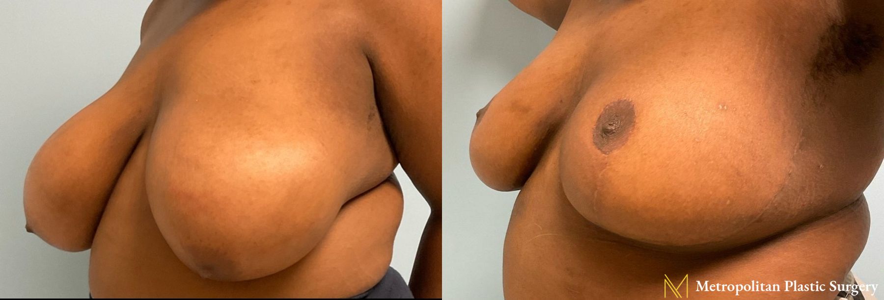 Before and after breast reduction surgery by Julia Spears MD - Angle 3