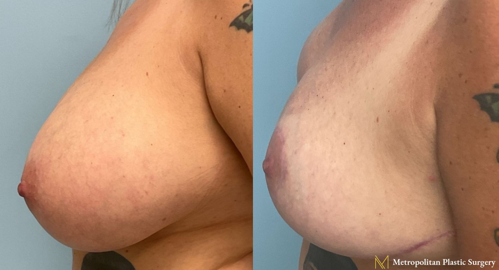 Before and after breast reduction surgery by Julia Spears MD - Angle 2