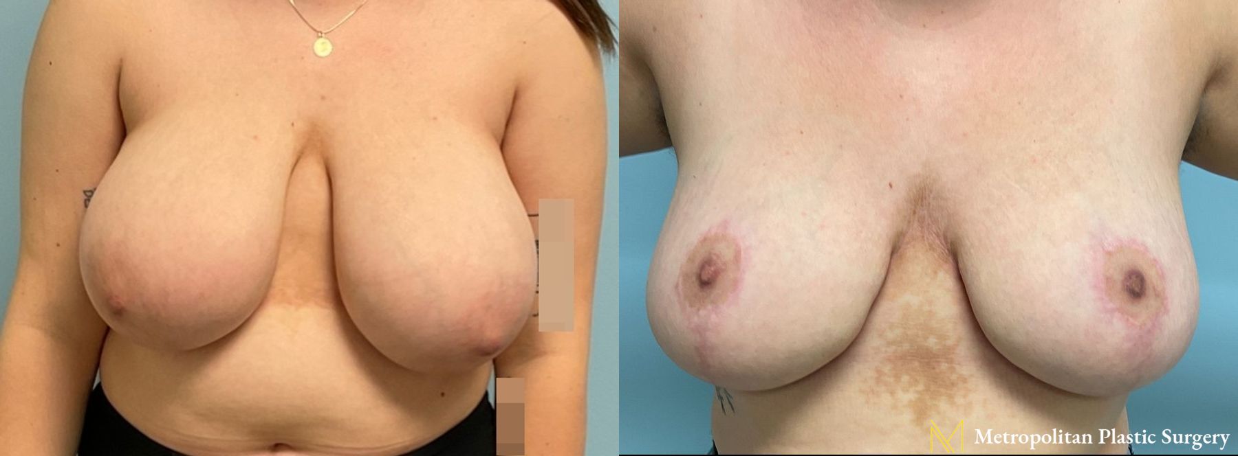 Before and after breast reduction surgery by Julia Spears MD