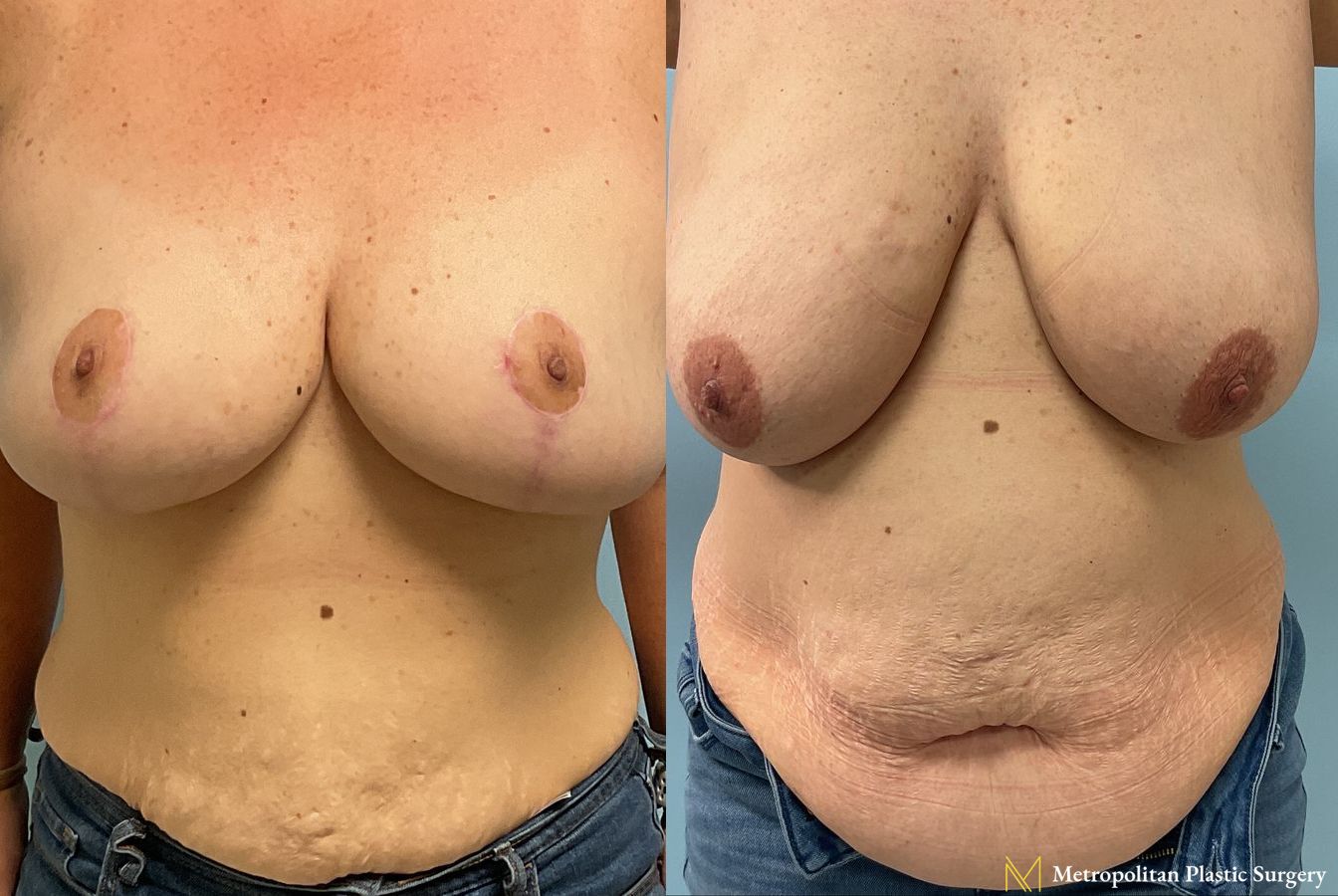 Before & After Breast Reduction (Mammaplasty) with Tummy Tuck by board certified Julia Spears MD