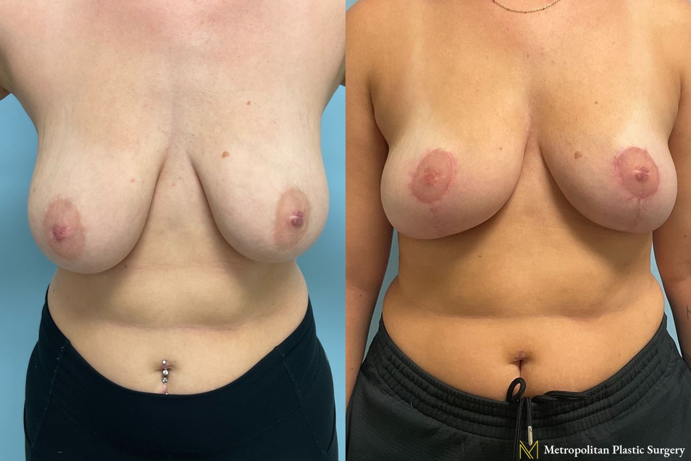 Before and after photos of breast reduction surgery by Julia Spears MD