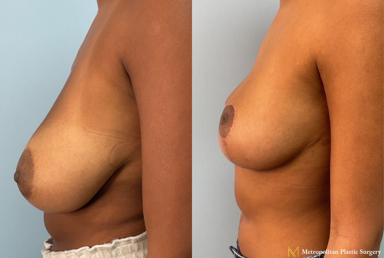 Before and after Breast Reduction case 26180 - Angle 2