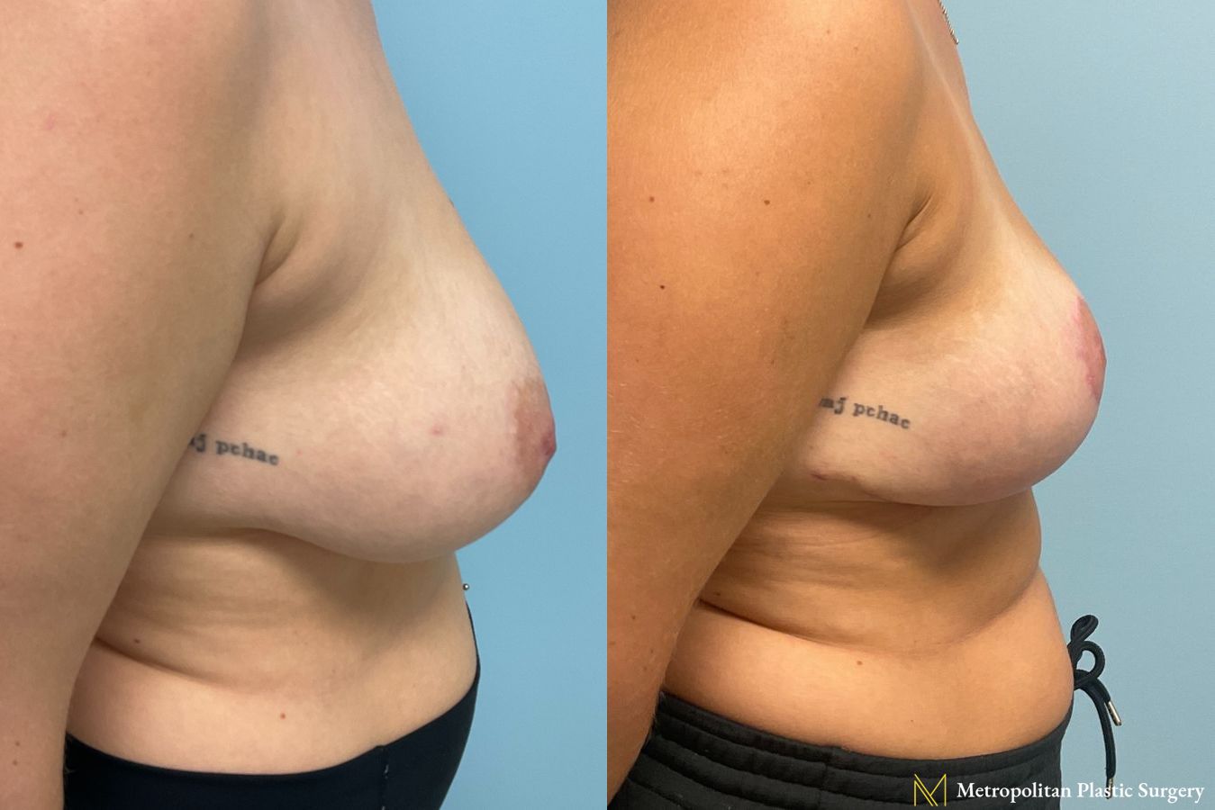 Before and after photos of breast reduction surgery by Julia Spears MD - Angle 4