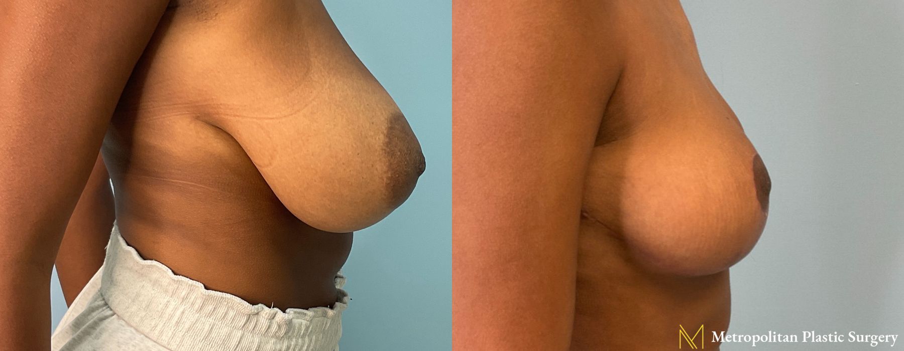 Breast Reduction - Thumbnail 2