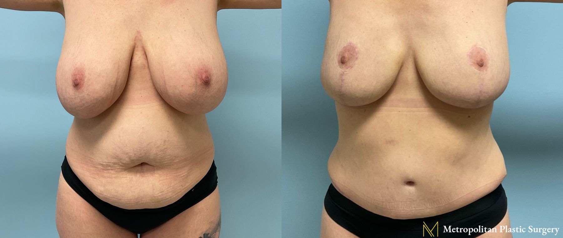 Before and after Tummy Tuck case 19254