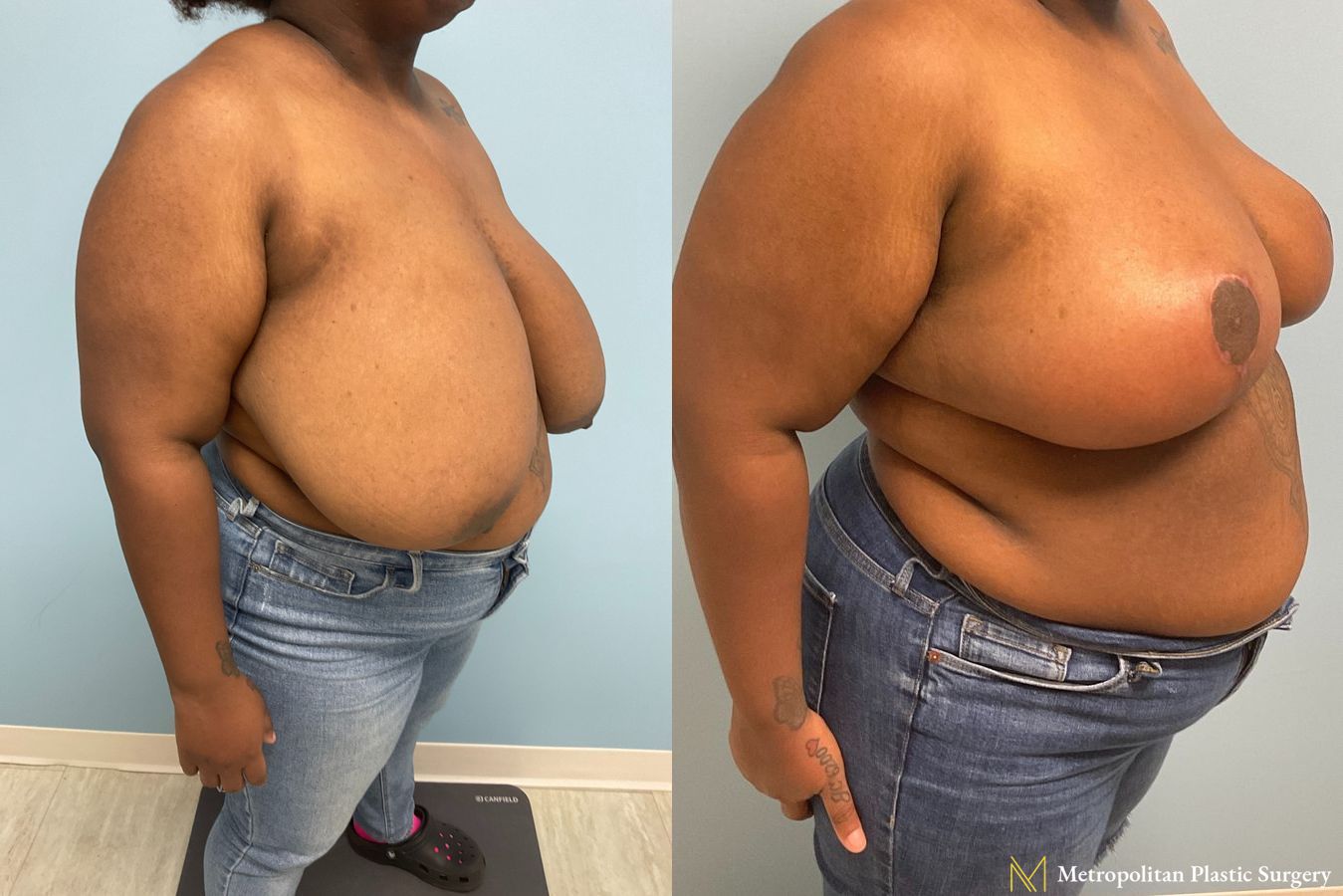 Before and after breast reduction surgery by Julia Spears MD - Angle 5