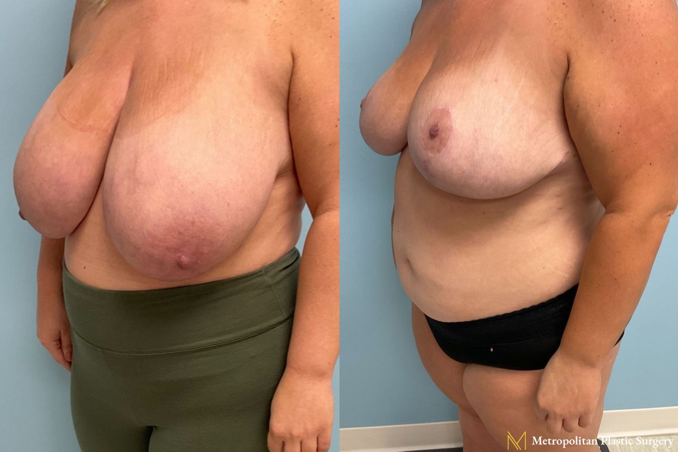 Before and after breast reduction surgery by Julia Spears MD - Angle 3