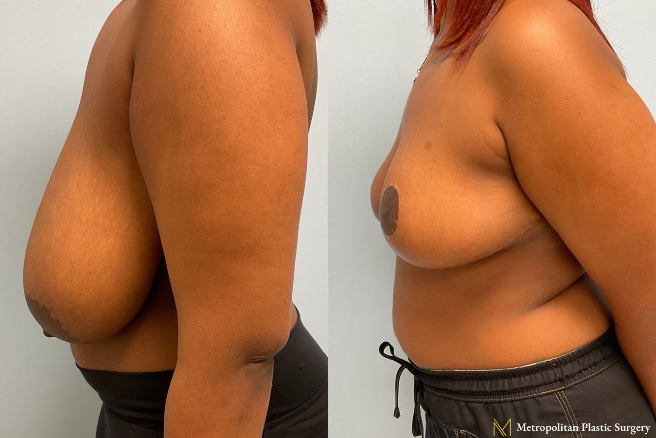 Before and after photos of breast reduction surgery by Julia Spears MD - Angle 3