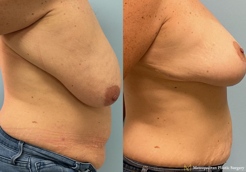 Before & After Breast Reduction (Mammaplasty) with Tummy Tuck by board certified Julia Spears MD - Angle 2