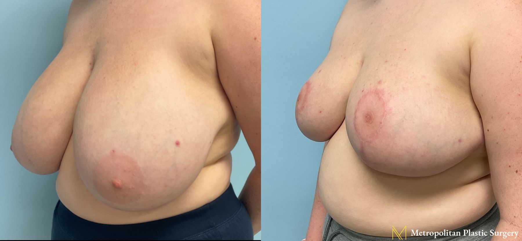 Before and after breast reduction surgery by Julia Spears MD - Angle 4